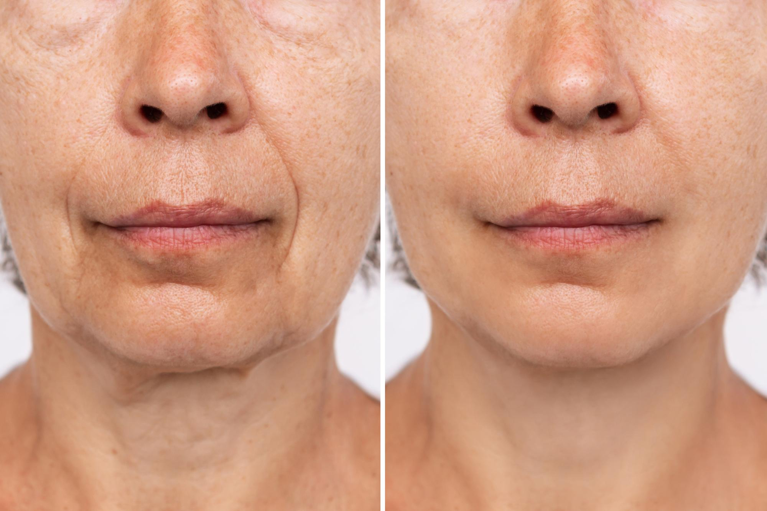 Antes e depois lateral do rosto
