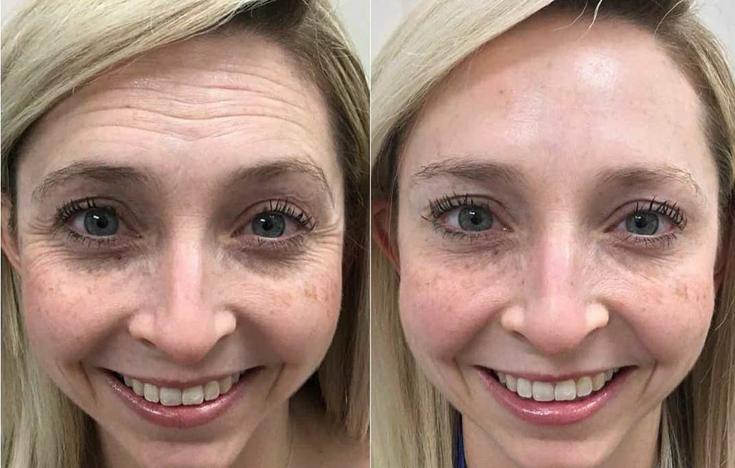Antes e depois do rosto